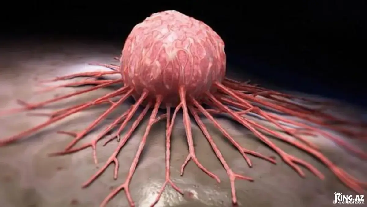 Alimlərdən inqilabi addım: Beyindəki şişlərə qarşı yeni metod